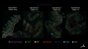 Tissue images showing progression of gut GvHD