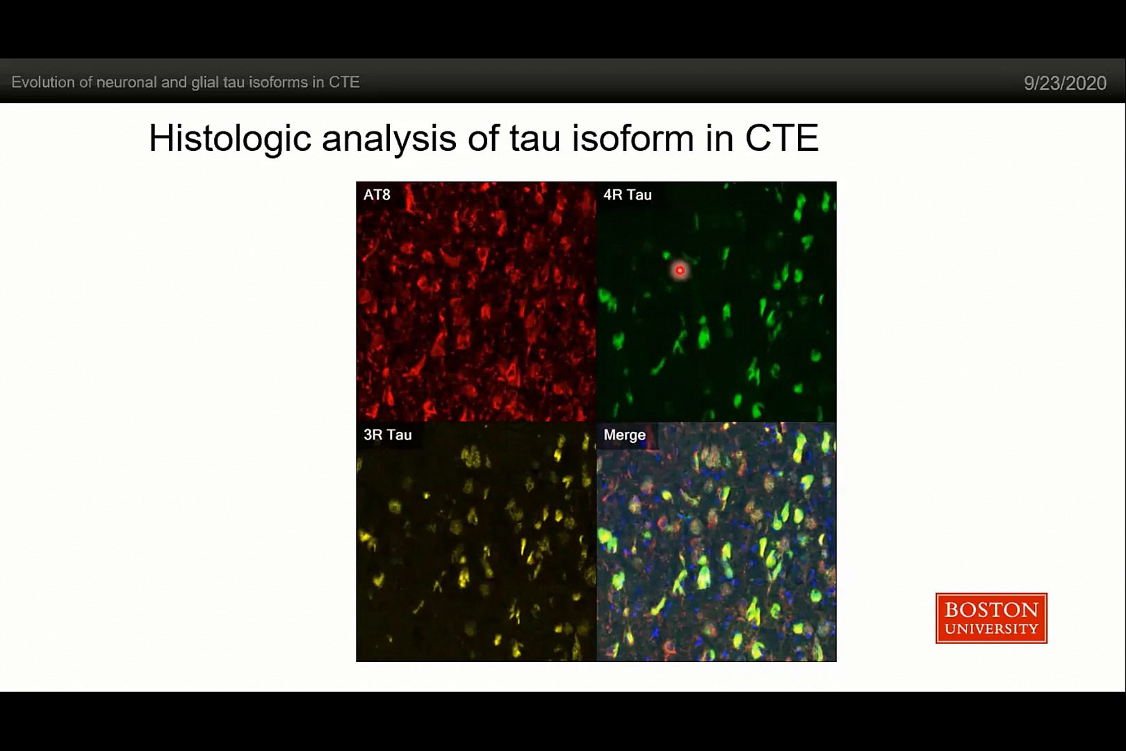 video-evolution-of-neuronal-and-glial-tau-isoforms-in-chronic-traumatic-encephalopathy-cte