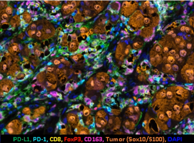 Melanoma tissue stained with 6-plex multiplex immunofluorescence panel