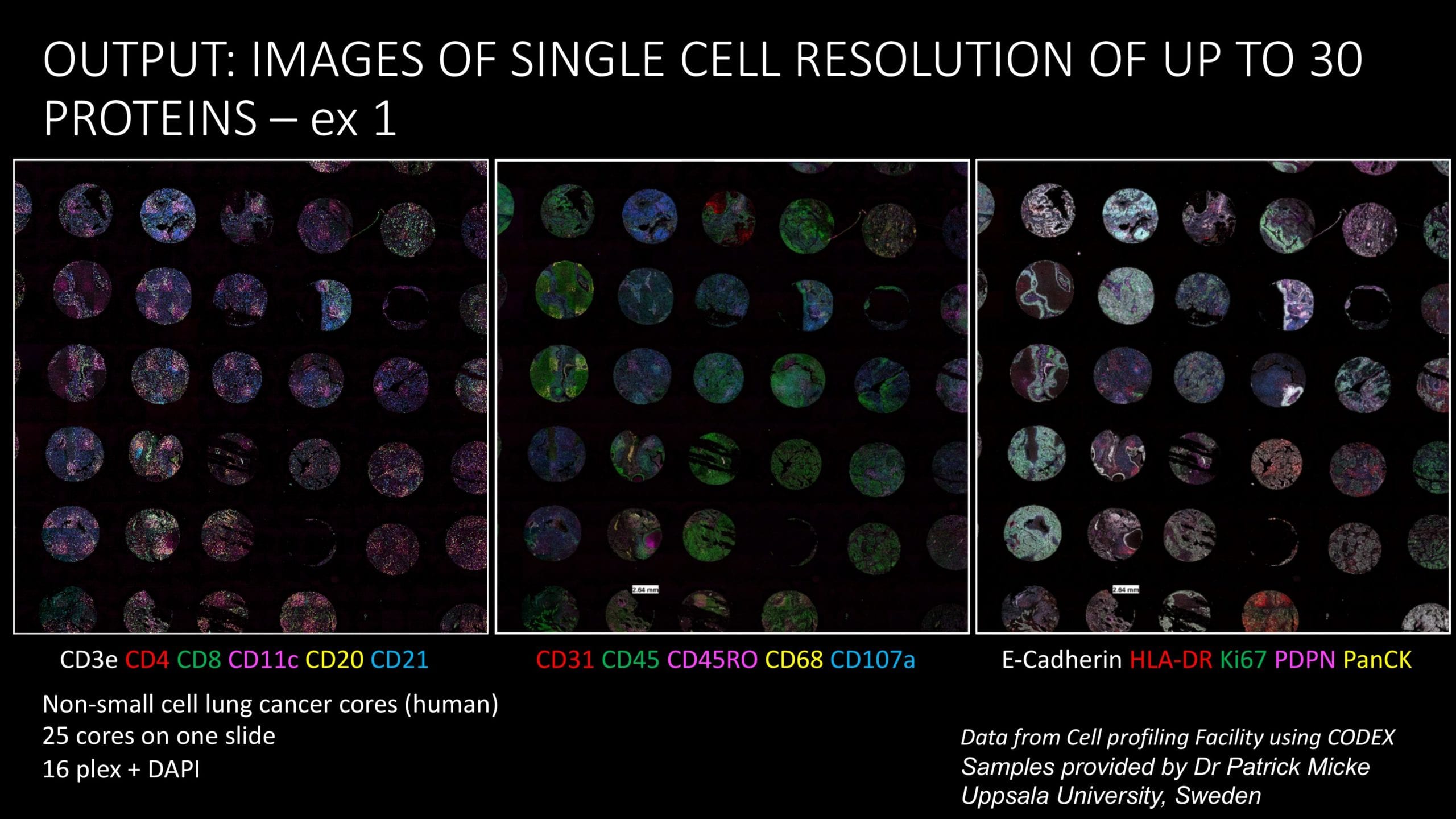 Images of single-cell resolution of up to 30 proteins. Non-small cell lung cancer cores (human). 25 cores on one slide. Data from Cell Profiling Facility using CODEX. Samples provided by Dr. Patrick Micke, Uppsala University, Sweden.