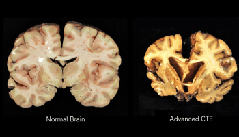 Image of a normal brain and a brain with advanced chronic traumatic encephalopathy.
